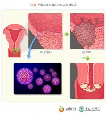 자궁경부암 예방접종, 만 12세 여성 청소년부터 권장…‘비용은?’