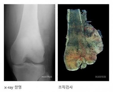 골육종, 무슨 병이길래?…‘10대 성장기에 가장 많이 발병’