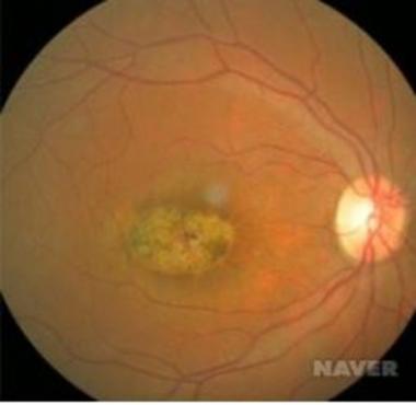 노인성 눈 질환 황반변성, 증상과 예방 방법은?